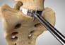 create 3d orthopedic surgery animation, knee replacement medical explainer video